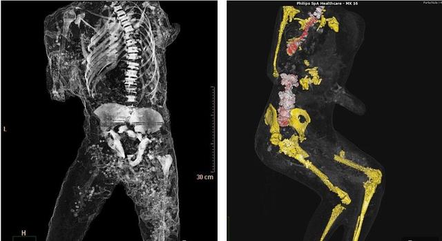 龐貝古城木乃伊接受CT掃描 死前驚恐表情曝光