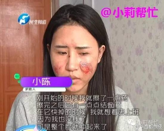 河南女子想喝水懶起床 躺著拿水壺遭燙傷毀容