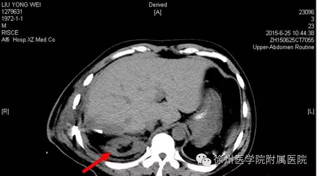 徐醫附院回應男子術後右腎失蹤：醫院閱片發現萎縮的腎臟