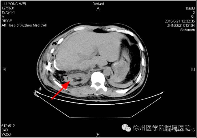 徐醫附院回應男子術後右腎失蹤：醫院閱片發現萎縮的腎臟