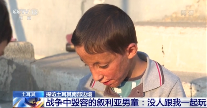 戰爭中毀容的敘利亞男孩：沒人跟我一起玩
