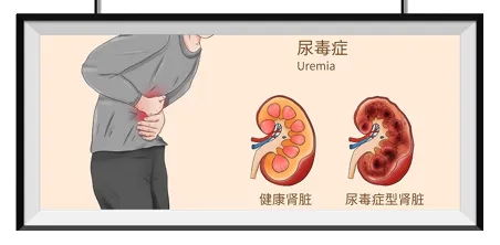 原來血液透析是這麼回事！4個關鍵問題，幫你讀懂生命守護技術 | 科普時間_fororder_3_副本