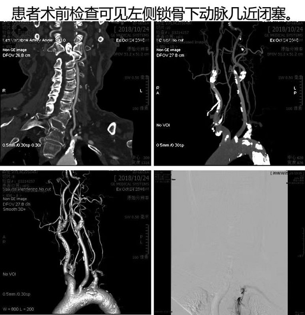 仁濟首次應用3D影像融合技術實施左鎖骨下動脈閉塞開通術