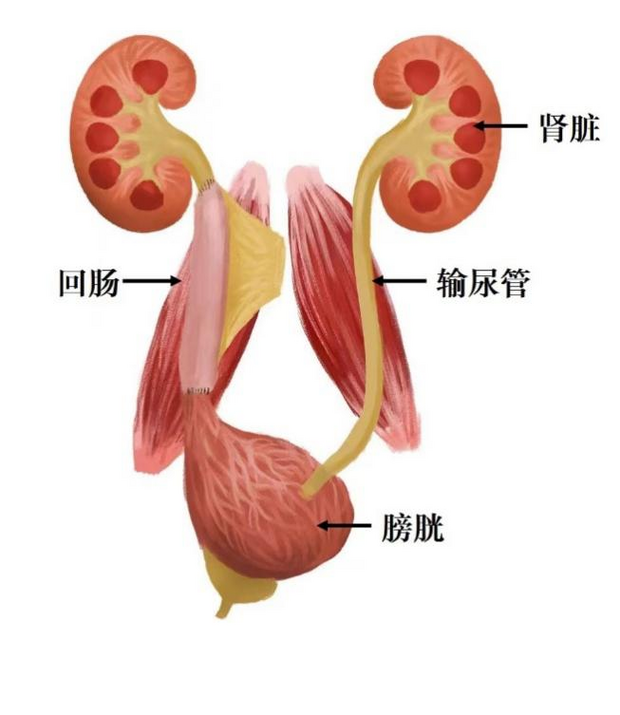 【原創】如何讓腸道化身輸尿管？上海專家巧用達芬奇手術機器人“移花接木”_fororder_圖片1