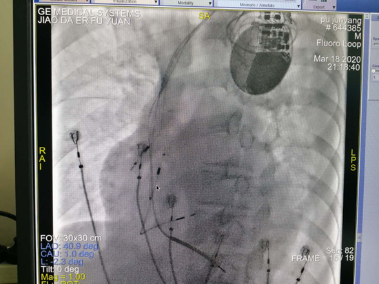 西安交大二附院心內科成功為一例嚴重心衰患者實施改良CRT
