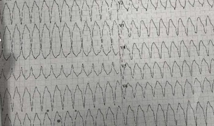 感冒誘發心肌炎差點要了命 醫生連續6天施救死裏逃生_fororder_6