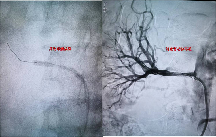 西安交大一附院血管外科楊林團隊成功救治未成年腎動脈閉塞患者_fororder_圖片3