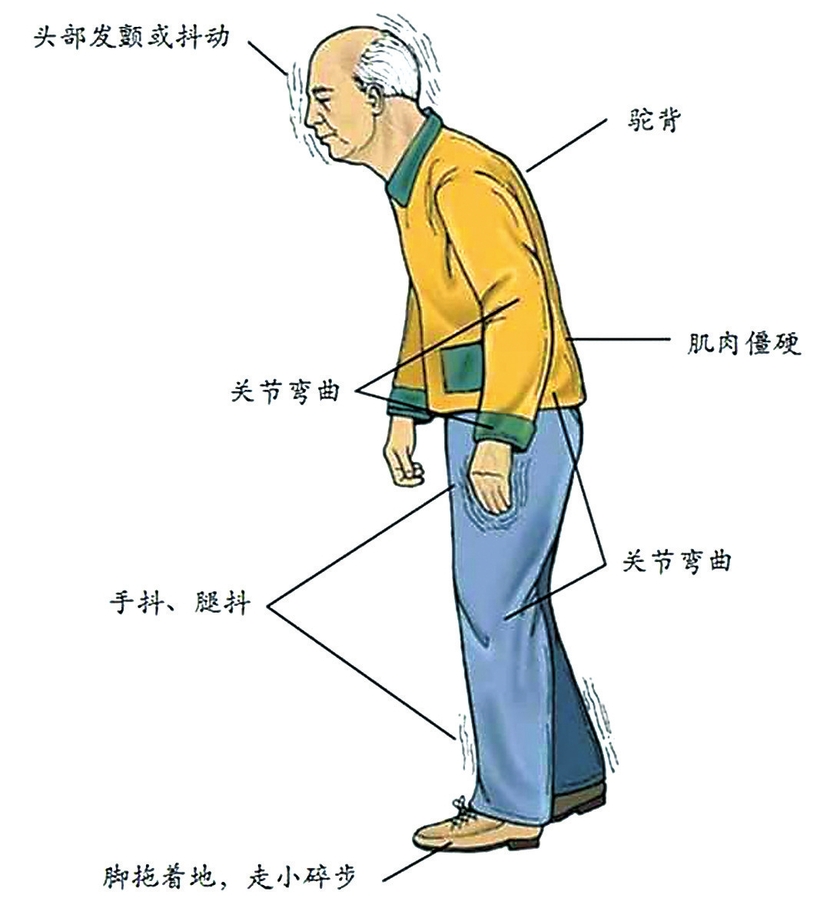 【健康醫藥（標題）】【關東黑土（長春）】【移動版（列表）】身體“抖僵慢” 警惕帕金森