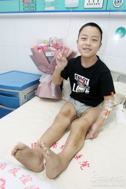 【三秦大地 西安＋移動列表】罕見雙下肢重度畸形少年西安圓夢 3個月後可正常行走