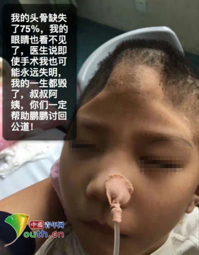 【今日看點】（頁面標題）6歲男童遭虐75%顱骨缺損 生母聲明永不放棄  （內容頁標題）陜西6歲男童遭虐75%顱骨缺損 生母聲明永不放棄